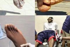 腳趾變形看著難受！看看詹姆斯在使用的腳趾分離器